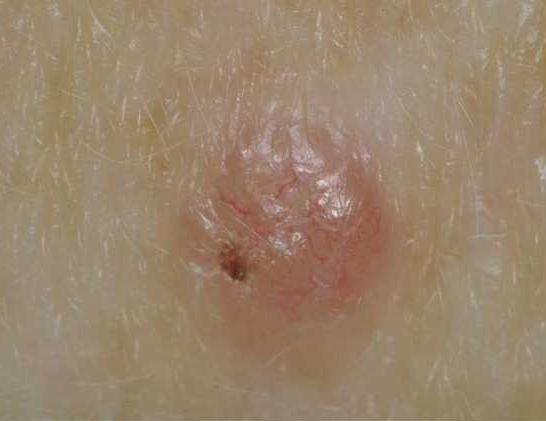 Basal Cell Carcinoma Pictures Early Stages